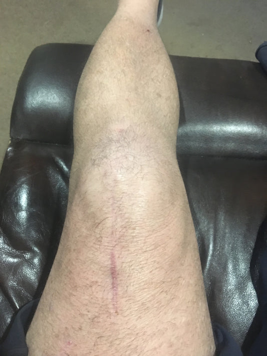 Emu oil application on scars