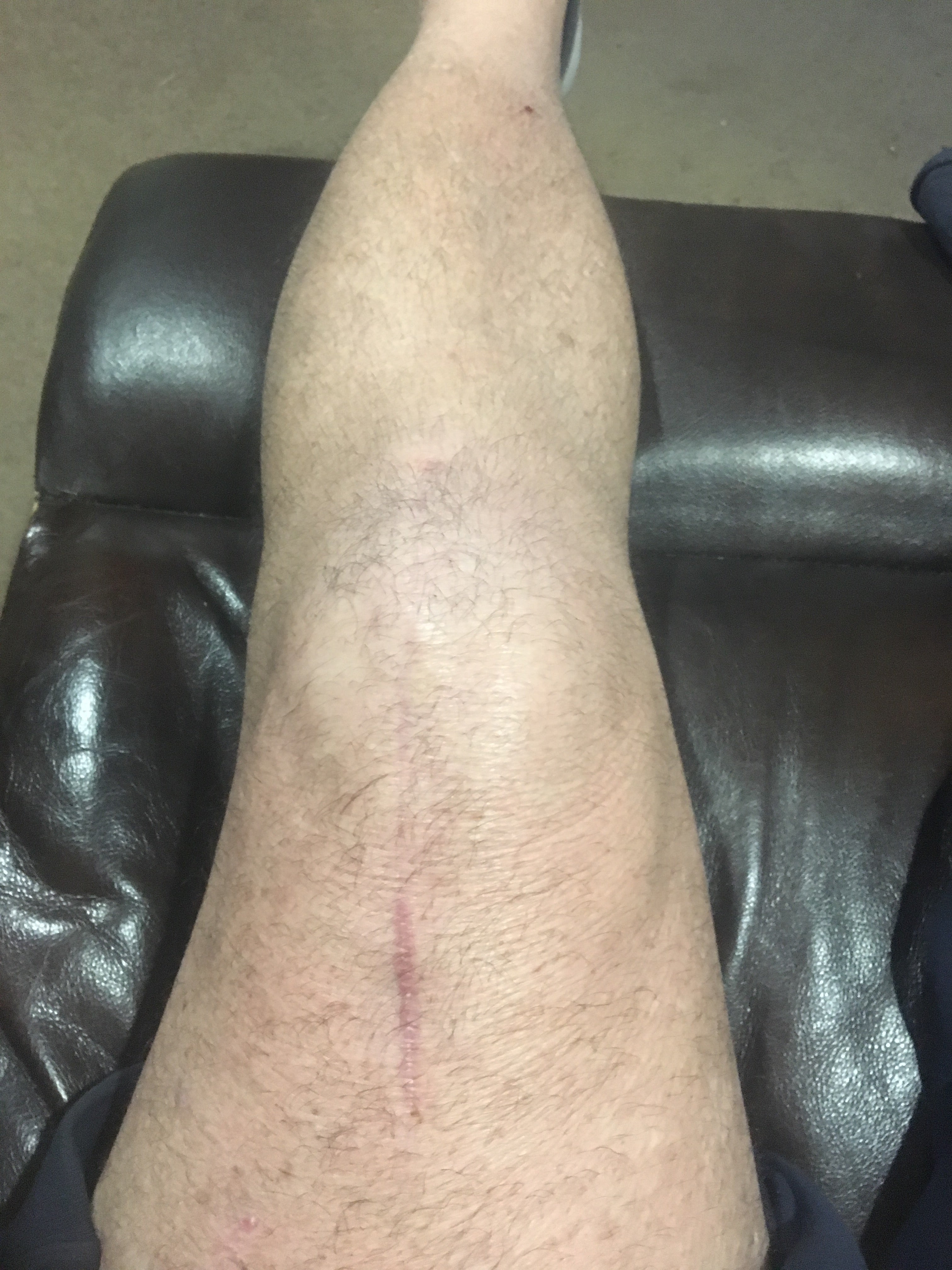 Emu oil application on scars